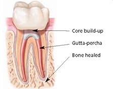 Endodontic treatment