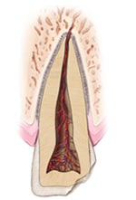 Chipped or Fractured Teeth